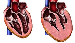 Увеличен левый желудочек сердца