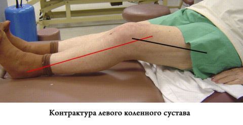 Контрактура колена значительно мешает больному при ходьбе.
