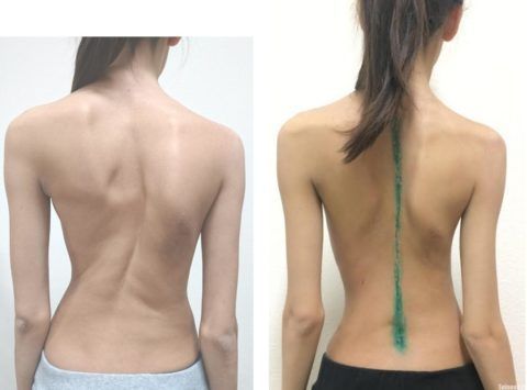Кривая спина: до и после операции