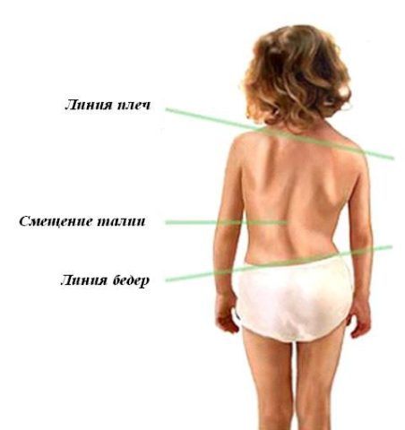 Кривая спина у ребенка