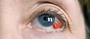 Причины и лечение ретинопатии