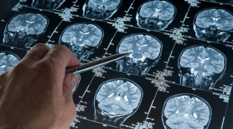 МРТ головного мозга позволяет выявить наличие в нём морфологических изменений