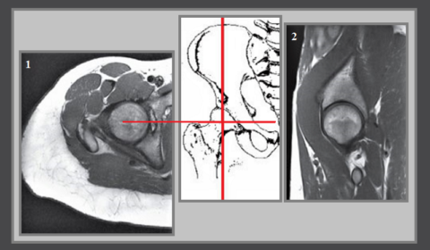 МРТ правого тазобедренного сустава в аксиальной (1) и фронтальной (2) плоскостях