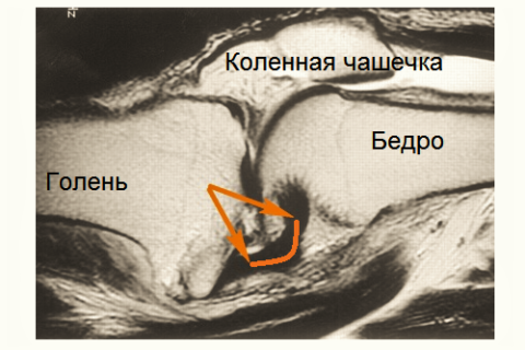 МРТ-снимок разрыва задней крестообразной связки колена