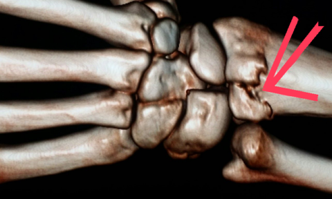 Мультиспиральная компьютерная томография лучезапястных суставов (МСКТ)