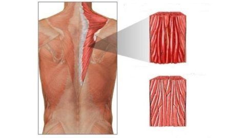 Воспаление чаще возникает в мышцах конечностей (икроножной, дельтовидной), спины и живота