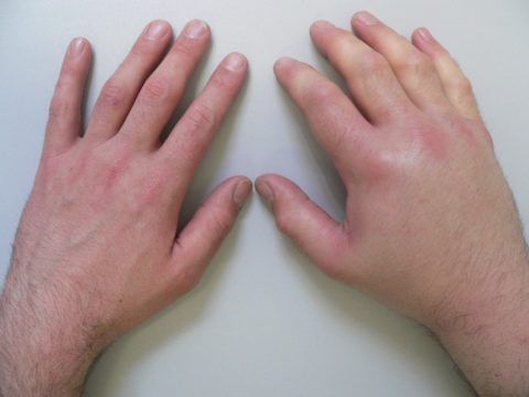 На фото отчётливо видно новообразования на суставной ткани между фаланг пальцев рук с отёком мягких тканей и гиперемией кожных покровов.