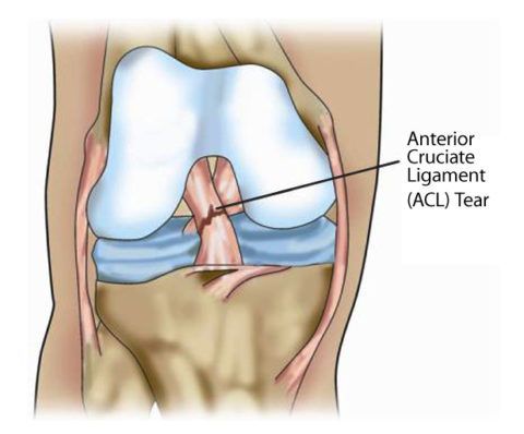 На фото представлен разрыв передней крестообразной связки колена.