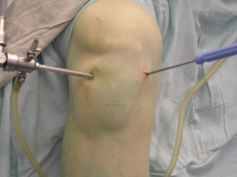 На фото представлено колено в процессе артроскопии