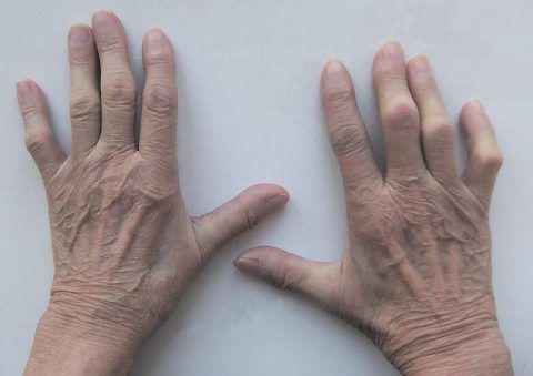 На фото руки пациента с воспалительным процессом в суставной части фаланг.