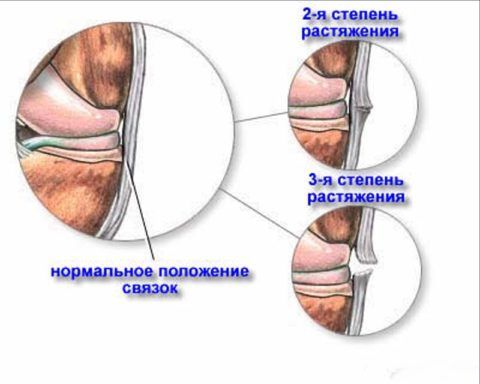 На картинке представлены нарушения связок локтя в зависимости от степени повреждения.