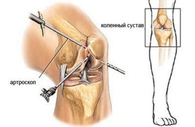 На колене обычно выполняют частичное иссечение пораженных тканей, при этом выбирают малотравматичный тип оперативного вмешательства (на фото).