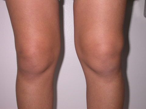 На последней стадии заболевания больное колено может сместиться по отношению к здоровому