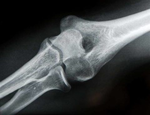 На рентгене выявлен артроз локтевого сустава, лечение которого начнется сразу после установления окончательного диагноза