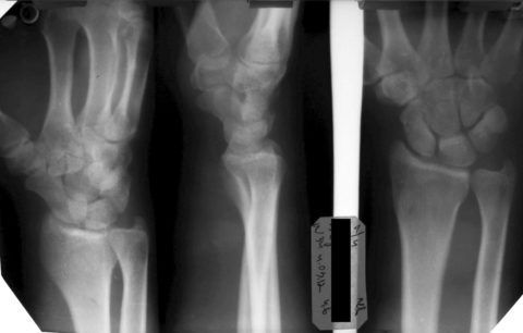 На рентгеновском снимке изображен лучезапястный сустав с неполным, продольным переломом лучевой кости.