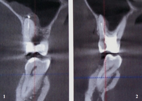На рентгеновском снимке норма (1) и дисфункция челюстного сустава — подвывих (2)