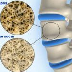 На третьей стадии остеопороза наблюдаются уже серьезные изменения в костной структуре