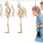 На третьей стадии остеопороза укорачивается рост больного и позвоночный столб значительно искривляется