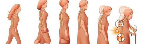 Об остеопорозе может свидетельствовать уменьшение роста человека, искривление позвоночного столба.