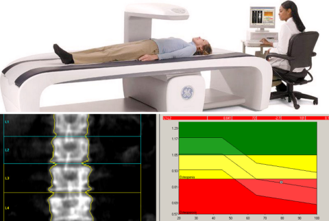 Обследование ДРА является «золотым» стандартом диагностики остеопороза