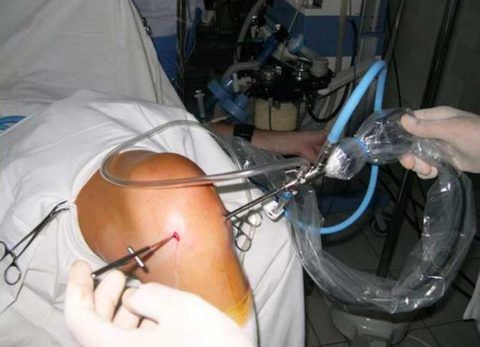 Операция с помощью артроскопа