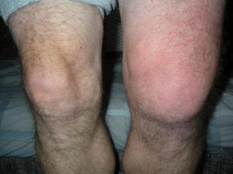 Опухло колено у пациента. Ежедневные нагрузки и подъёмы тяжести выводят хрящевую и суставную ткань из строя, вызывая ряд заболеваний.