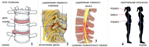 Осложнения остеохондроза – грыжа диска (1), радикулит (2), стеноз (3), искривление (4)