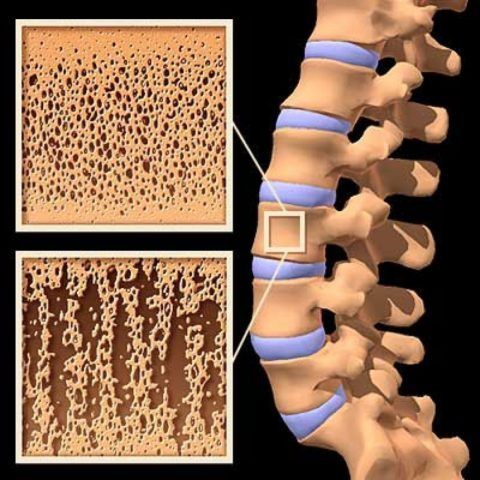 Основные симптомы остеопороза позвоночника – боли