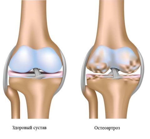 Остеоартроз – одна из причин, почему болят суставы рук