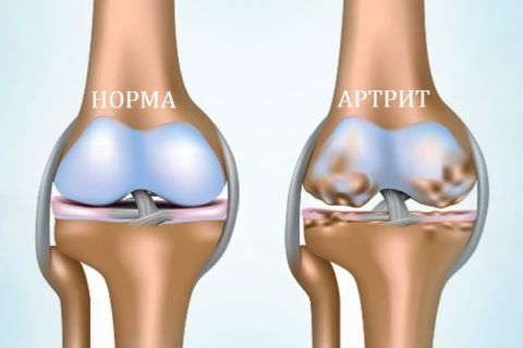 Острый артрит колена в большинстве случаев возникает вследствие уже имеющегося заболевания тканей сустава.