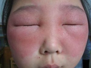 Давление из-за аллергии