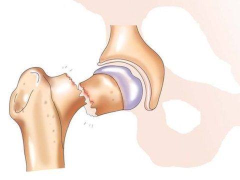 Перелом шейки бедра - опасное и тяжелое повреждение