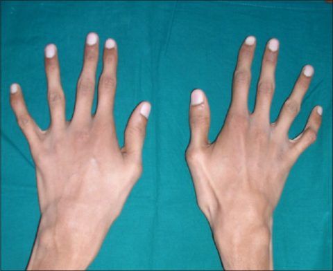 Первая степень изменения фаланг пальцев рук.
