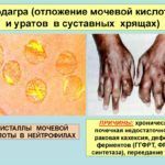 Подагра – одна из основных причин образования шишек на пальцах