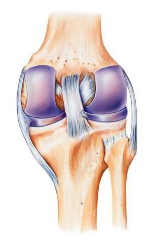 Повреждение задней крестообразной связки колена.