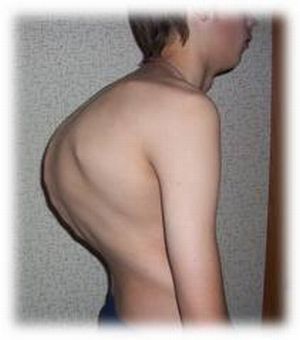 Появление углового искривления (горба) обусловлено деформацией позвонковых тел.