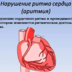 При неэффективности лечебных мер и дальнейшем прогрессировании патпроцесса может появиться аритмия, которая повлечет остановку сердца у больного.