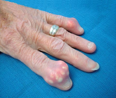При остеоартрозе могут формироваться болезненные шишки на пальцах значительных размеров.