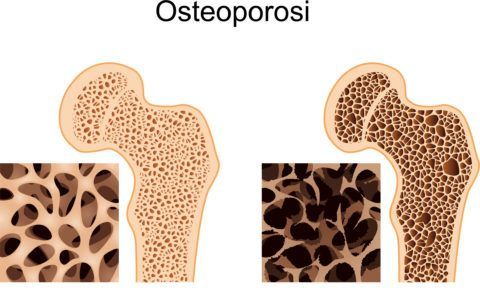 При остеопорозе происходит «размягчение» костей вследствие снижения костной массы.