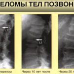 При прогрессирующем остеопрозе наблюдаются изменения на рентгеновских снимках с течением времени