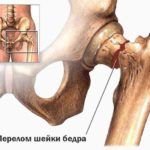При прогрессирующем разрушении костей повышается риск возникновения переломов