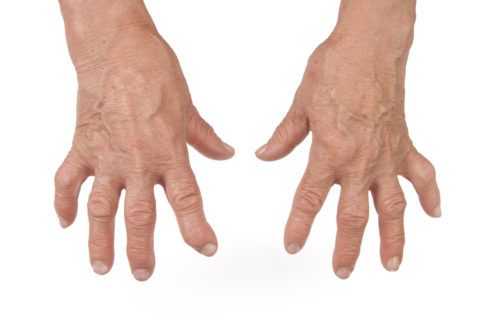 Руки ноют, и сильно крутит (ломят) суставы рук - возможно, это ревматоидный артрит