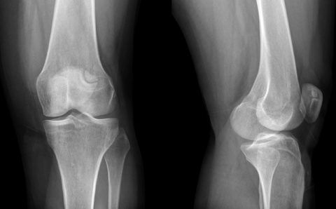 При травмировании колена следует обязательно сделать рентген.