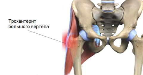 При трохантерите ТЗБ соединения патпроцесс затрагивает вертел бедренной кости, часто сухожилия и близрасположенные мягкие ткани.