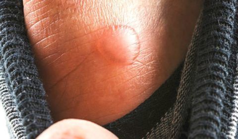 При укусах насекомых могут болеть сочленения.