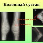 Причиной возникновения остеопроза колена могут послужить его травмы.