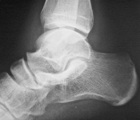 Признаки артрита на рентгене
