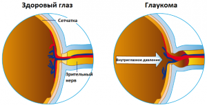 Глаукома и катаракта