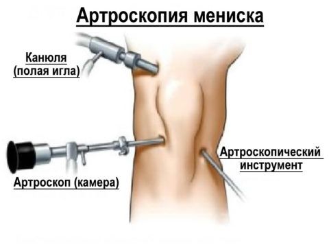 Проведение артроскопической процедуры при лечении мениска колена.