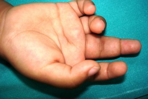 Проявление ревматизма на пальцах рук в детском возрасте.